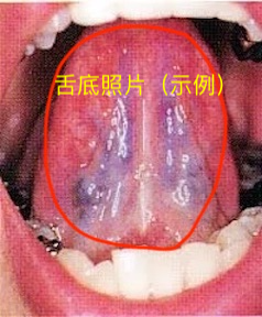 舌底照片示例